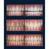TOSOWOONG SOS Teeth Whitening Glow Clinic Glow White Toothpaste