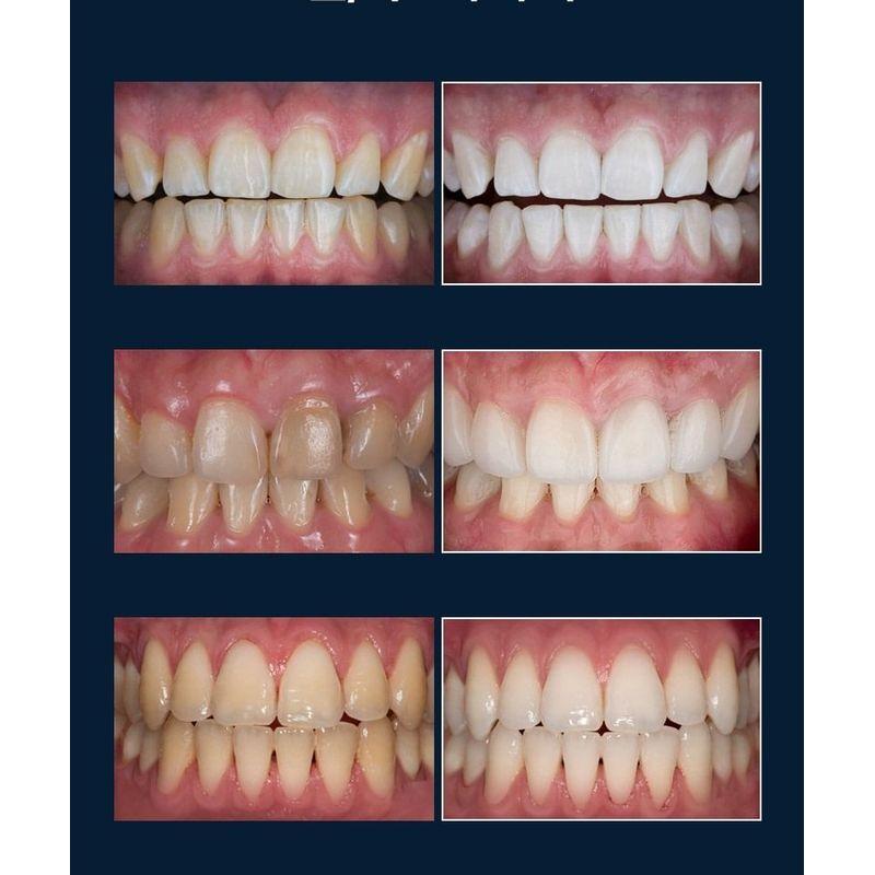 TOSOWOONG SOS Teeth Whitening Glow Clinic Glow White Toothpaste