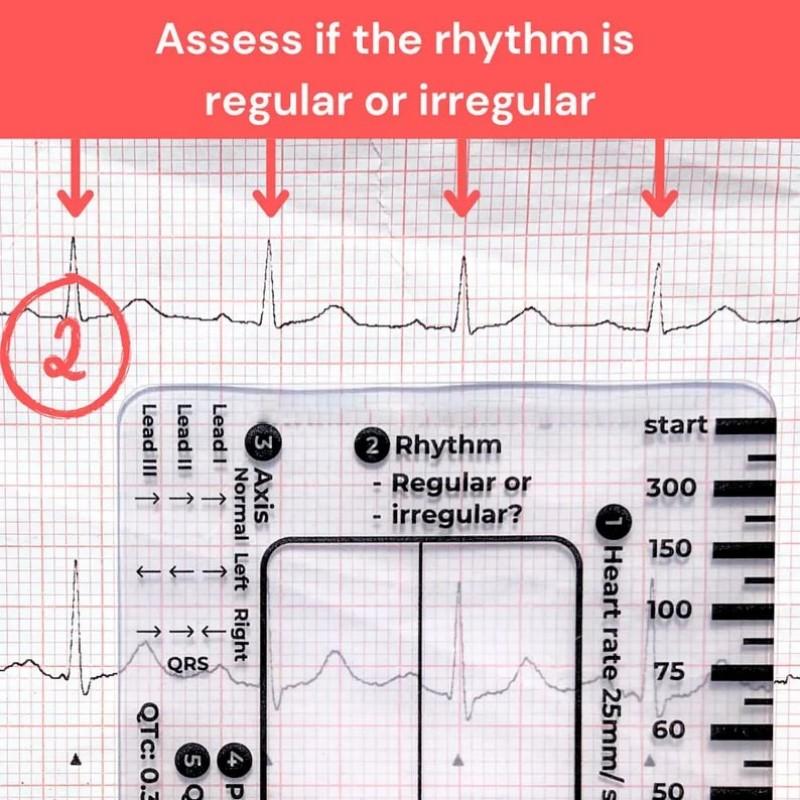 EKG 7stupňové pravítko Přenosné průhledné 7stupňové pravítko Měřicí nástroj Plastové pravítko Měřicí nástroj pro interpretaci EKG