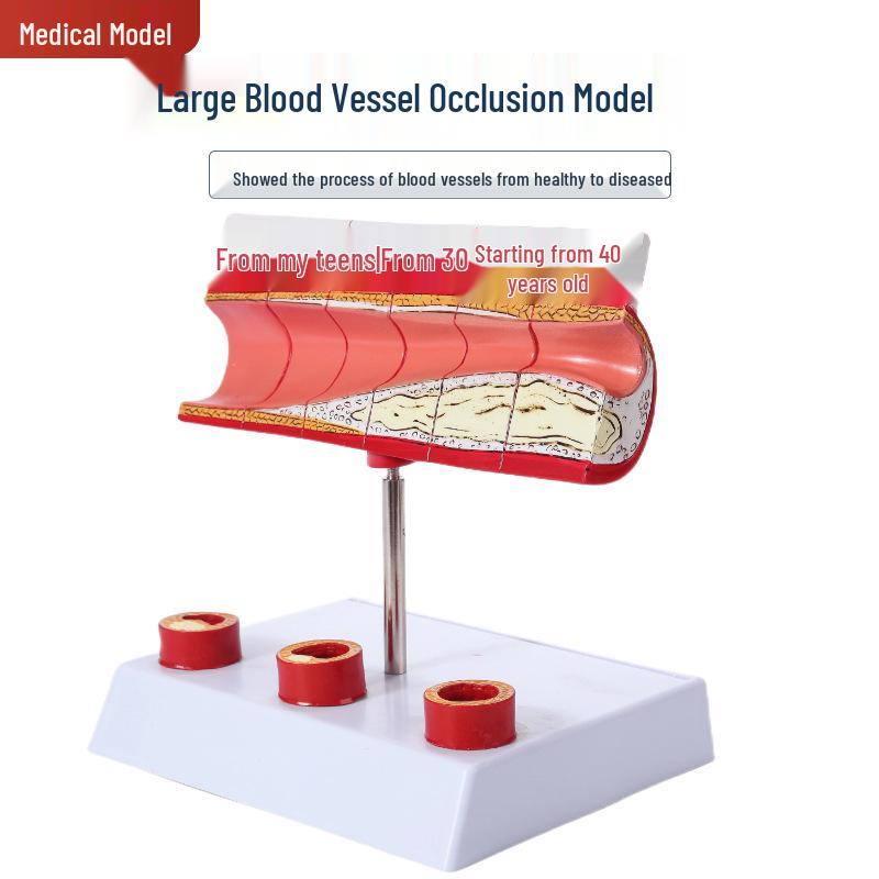 Human Arteriosclerosis and Atherosclerosis Pathology Model