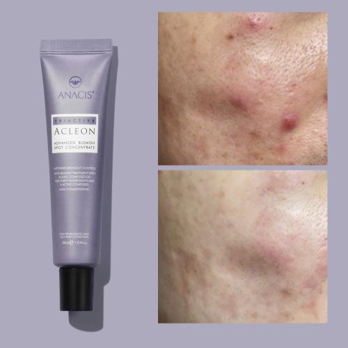 Acleon Youth Acne Skincare Ampoule & Spot Treatment Duo