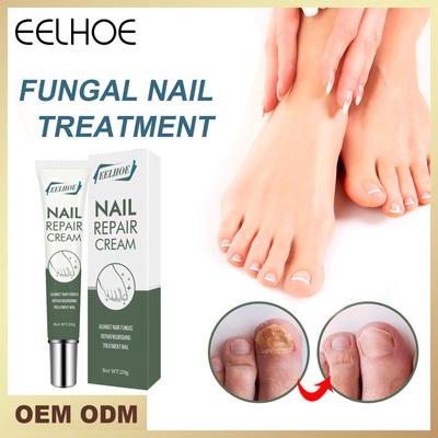 Sérum pro ošetření plísní nehtů Neht Noha Gel na odstranění plísně nehtů proti infekci Onychomykóza Repair Essence Krém na nohy