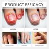 Fungal Nail Hands And Feet Soft Nail Inlaid Nail Thickening Bright Nail Furrow Gray Nail Care Patch   21pcs