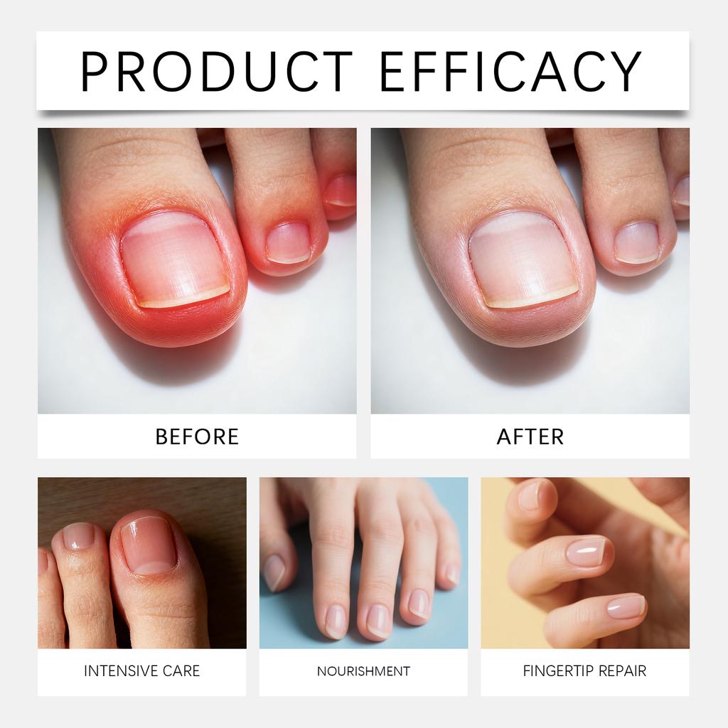 Fungal Nail Hands And Feet Soft Nail Inlaid Nail Thickening Bright Nail Furrow Gray Nail Care Patch 21pcs