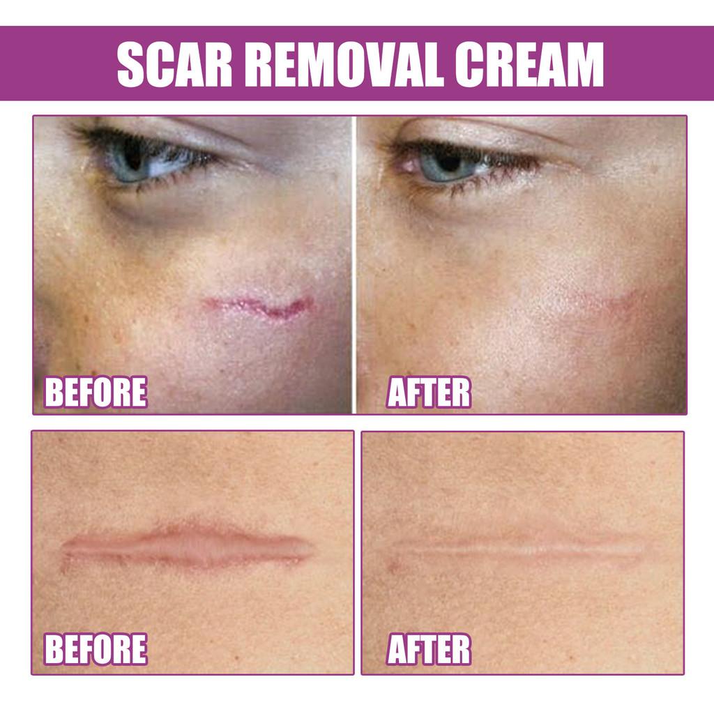 Ouhoe Scar Care Cream For Smoothing And Moisturizing Skin With Gentle Formula