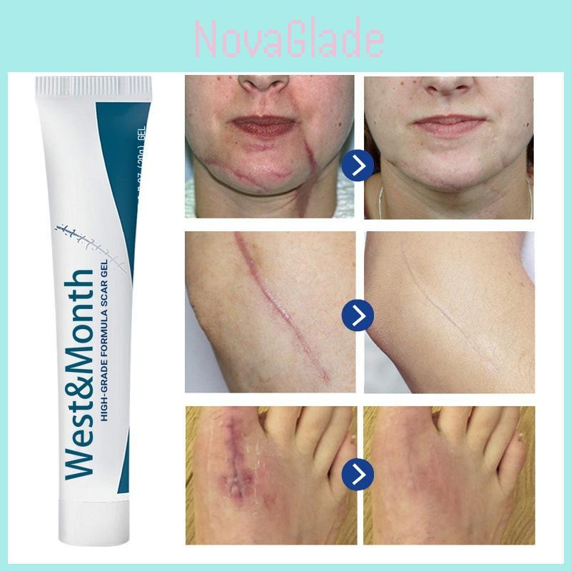 West Month Scar Diminishing Gel For Surgical Scars And Pregnancy Skin Care 20g