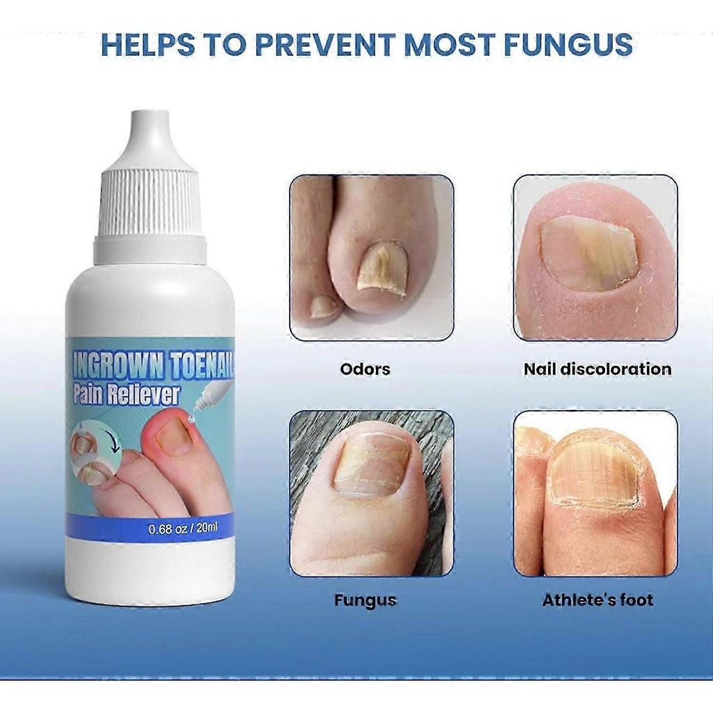 Ingrown Toenail Treatment Extra Strong,Ingrown Toenail Drop,Cuticle Care Oil for Ingrown Toenails Ingrown Toenail Tools