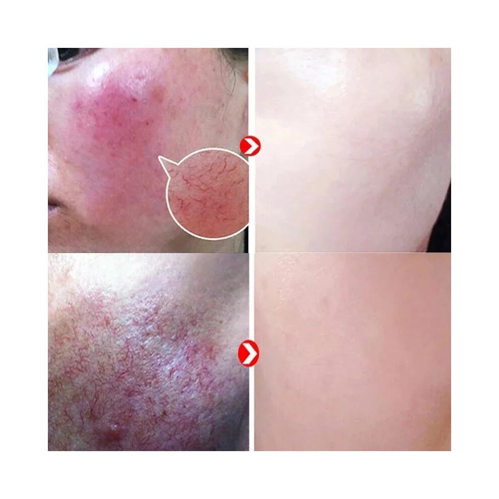 Repair Facial Redness Serum Instant Spider Vein Remove Sensitive Skin Sooth Anti Redness Rosacea Treat Lotion Korean Cosmetics