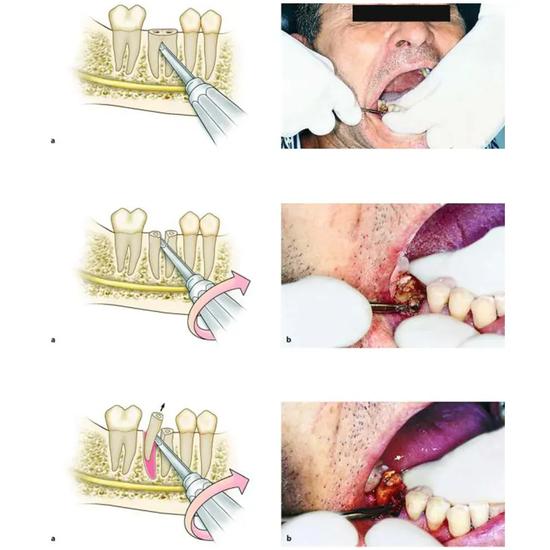 GDC Root Elevators Lindo Levian Curved - (4x8mm) Standard (Lllc4)