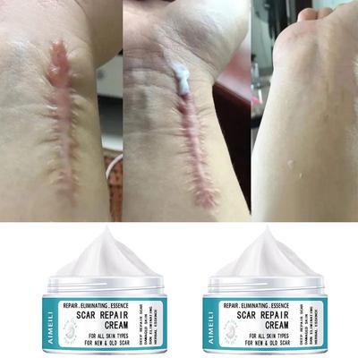 Ätherisches Öl zur Narbenentfernung, Ultra-Premium-Verbindung, ätherische Öle für Massage, Gesicht, Körper, Hautpflege, Narbenreparatur, Akne, Verbrennungen