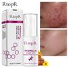 Propolis Reparasjon Akne Lysende Serum Akne Arr Flekker Rengjøring Serum Krympe porene Eliminerer Akne Behandling Oljekontroll