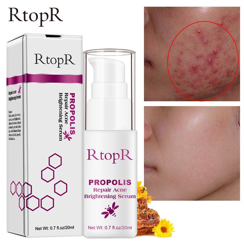 Propolis Reparasjon Akne Lysende Serum Akne Arr Flekker Rengjøring Serum Krympe porene Eliminerer Akne Behandling Oljekontroll