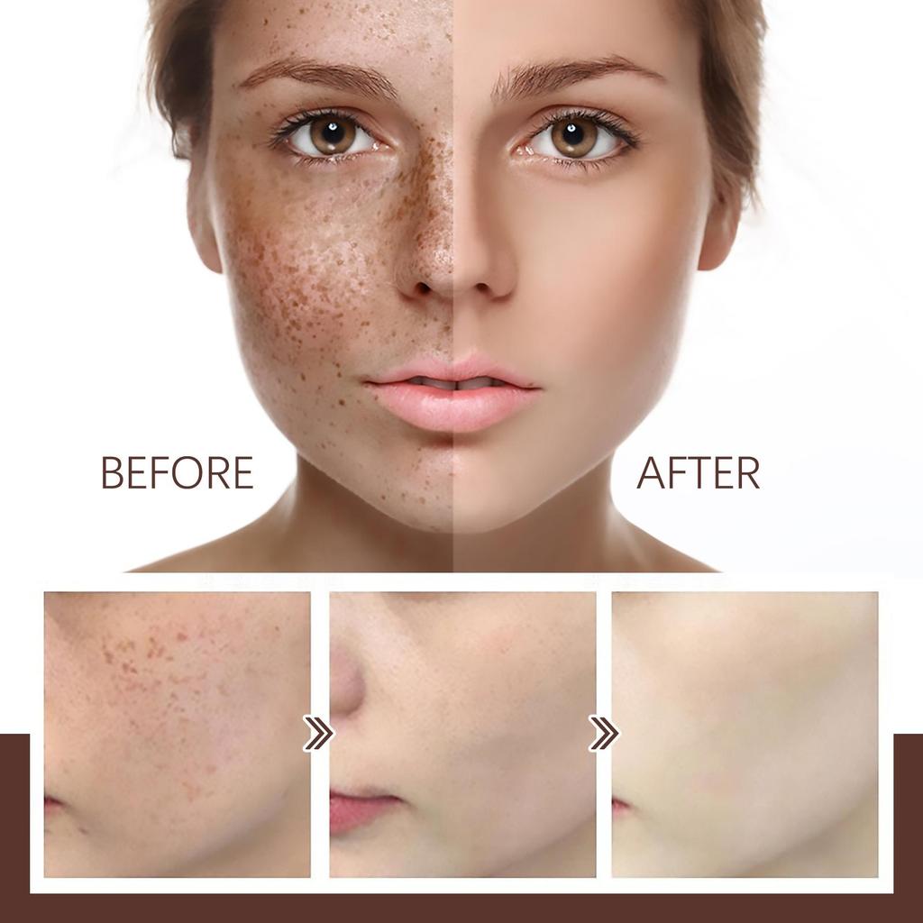 Spots Peel off Facial Mask Freckle Pigmentation Removal Cream Chloasma Care Dark Spot Correction Glow Whiten Peeling Mask Strong