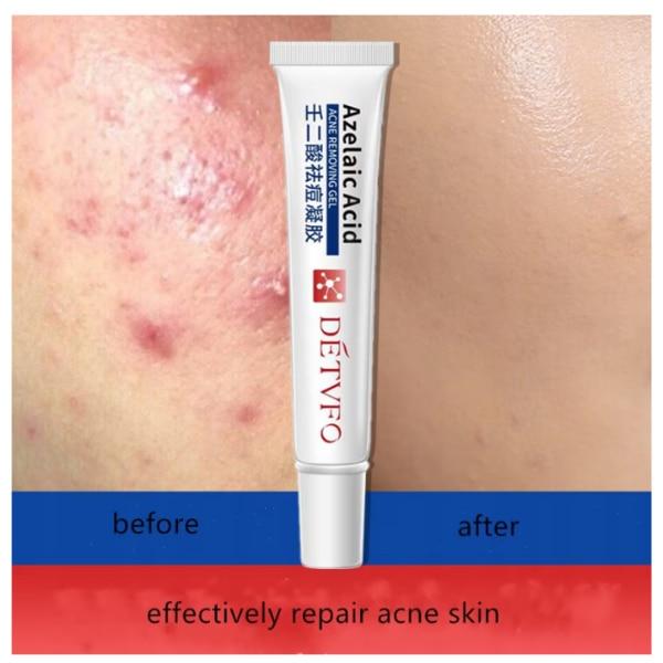 Azelaic Acid Acne Gel Cream 20g Oil Control Repair Dark Spot Fade Gentle Face Care