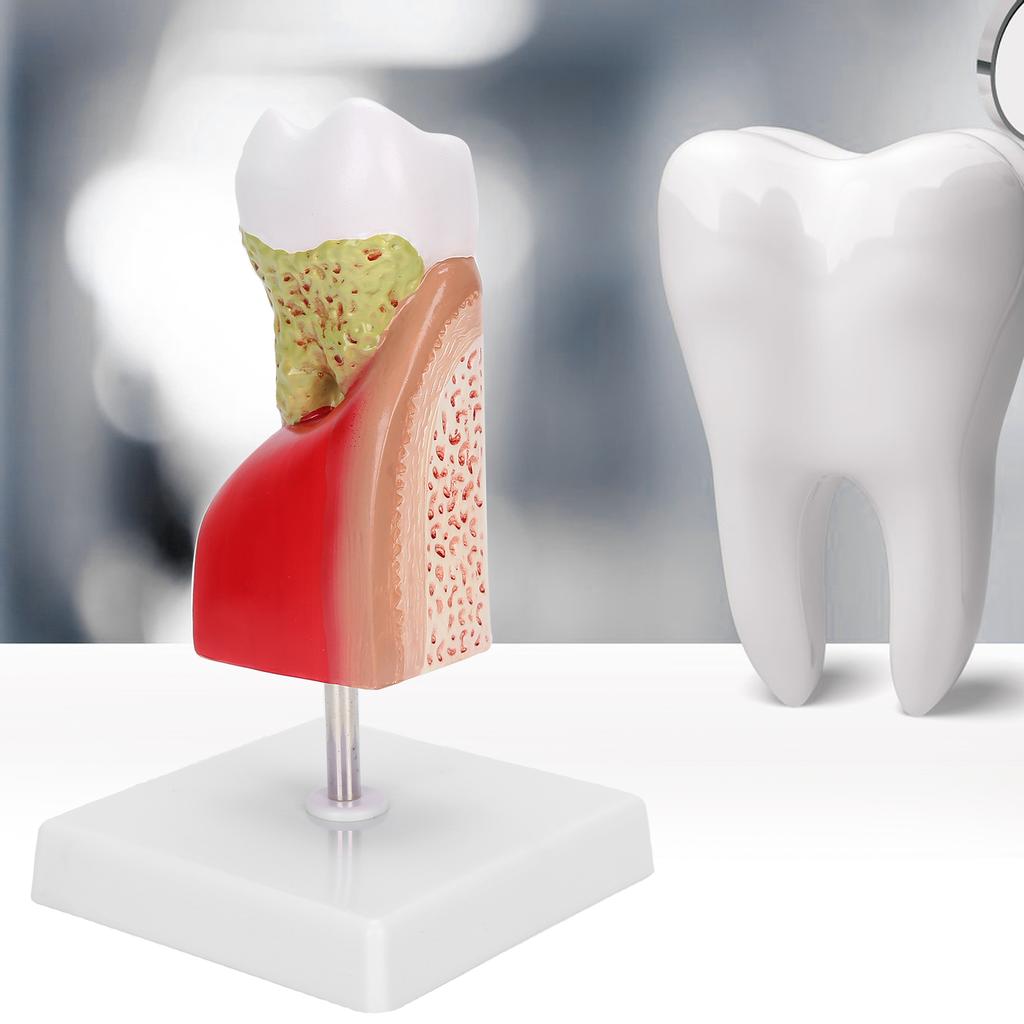 Zubní kaz Model zubu Zubní model pro výuku Školení Vzdělávání pacientů