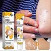 Vitiligo Treatments Cream Portable Anti-itch Body Care Cream for Skin Care