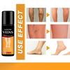 New Varicose Veins Spray – Natural Herbal Formula for Fast Relief | Reduces Pain & Promotes Circulation | Easy-to-Use Spray for Legs, Ankles & Fee