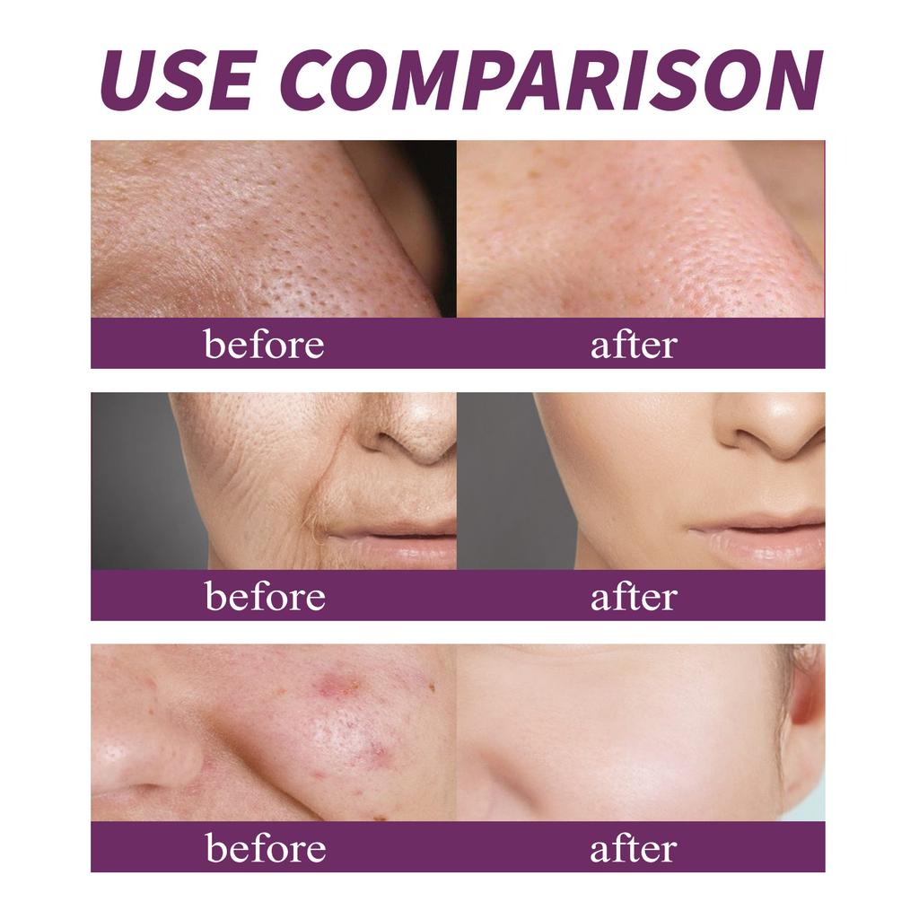 20% Niacinamide B3 Concentrated Skincare Anti Aging Color Removal Pore  Shrinking Spot Fading Wrinkles and Wrinkles 20ml