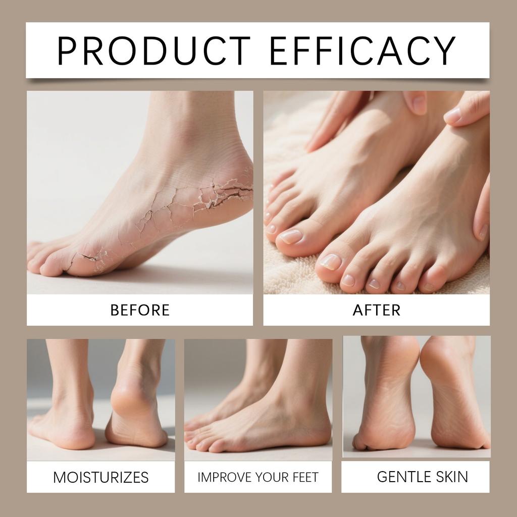 Urea Cream, Foot Balm Sticks Dryness, And Foot Moisturizing Sticks Improve Chapping And Roughness