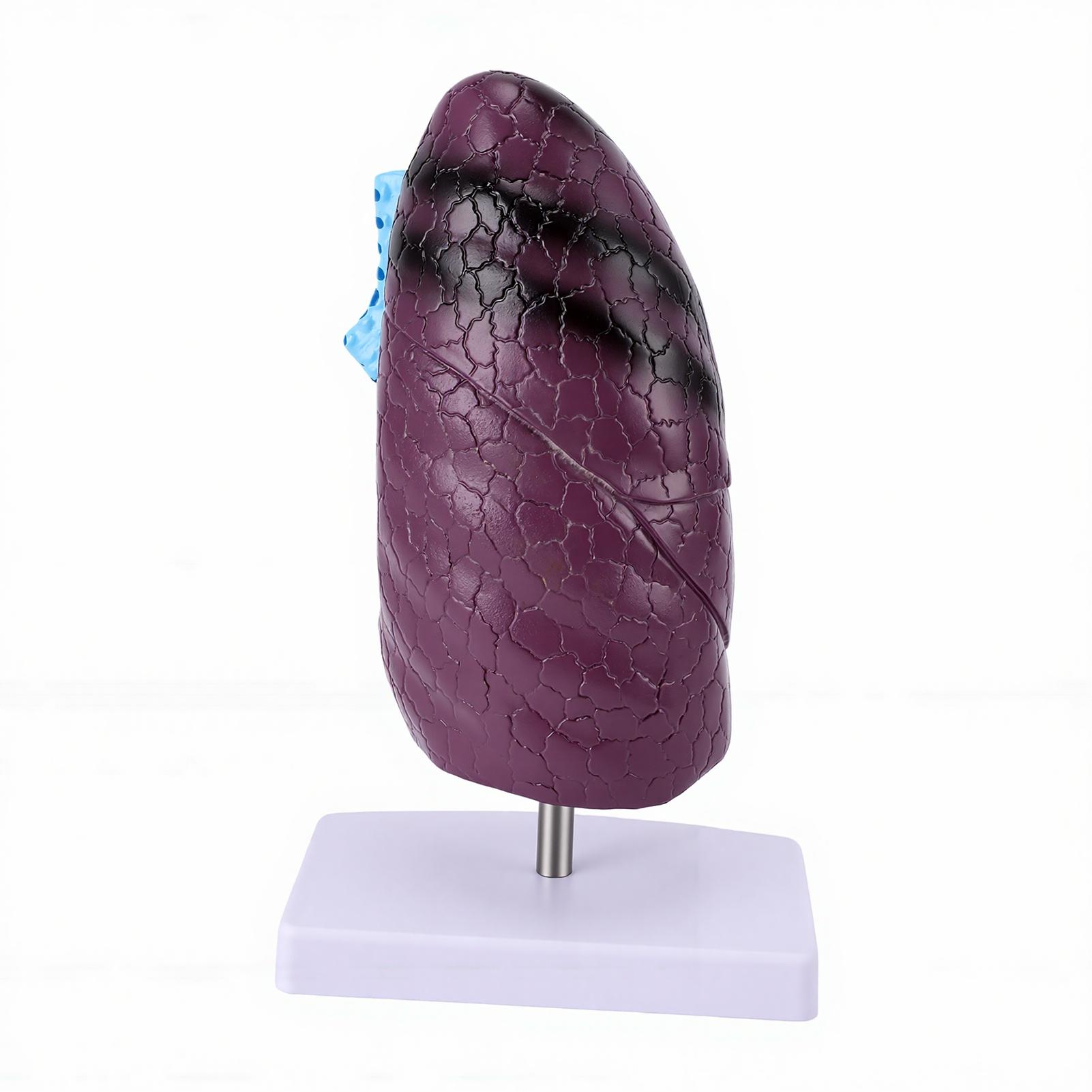 Lung Anatomy Model Smoking Lung Model Comparison Teaching Tool for Anatomy Education