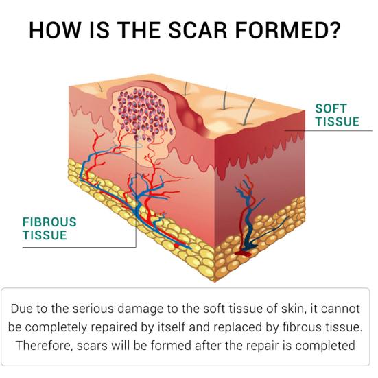 Breylee Acne Scar Removal Cream Stretch Marks Treatment Repairing Skin Care