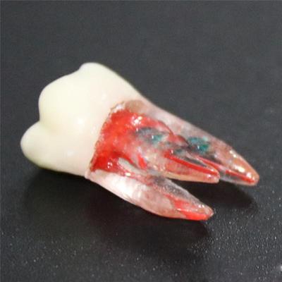 Dental Tooth Model Root Canal RCT Practice Pulp Cavity Clear Resin Teaching 1:1