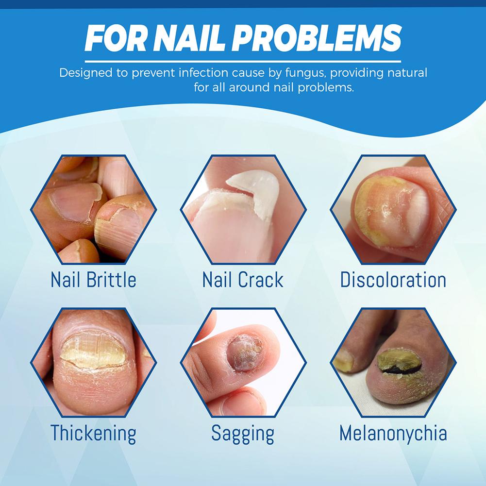 Nail Fungus Laser Cure Machine Foot Care Device for Nail Treatments Anti Infection Paronychia Onychomycosis Nail Removal Care