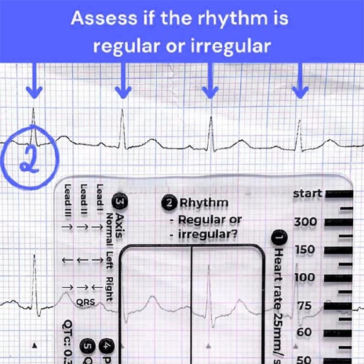 Electrocardiogram Assessment Tool 7 Step Ruler Card For Hospitals Clinics Healthcare Professional And Medicals Students