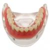 Modelo Dental de Media Mandíbula con Demostración de Implante Dental y Restauración de Dentadura Postiza
