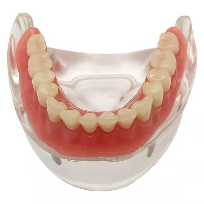 Modelo Dental de Media Mandíbula con Demostración de Implante Dental y Restauración de Dentadura Postiza