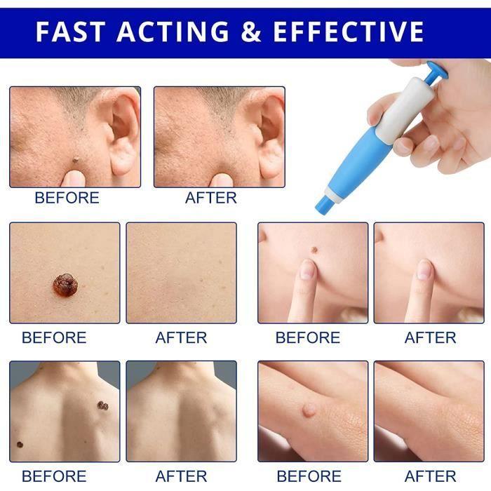 Skin Tag Remover kit,Appareil Pour Enlever Acrochordon Petit, Moyen,Grand Sans Cicatrice Indolore Kit D'élimination Des Acrochordons