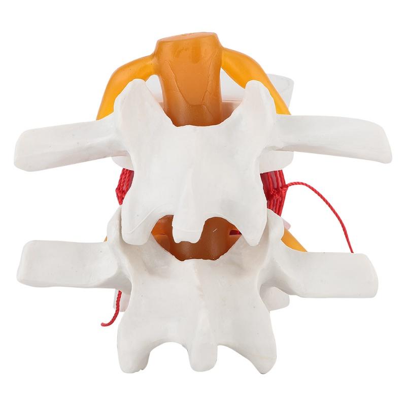 1:1.5 Medical Demonstration Model Of Lumbar Vertebral Spine Human Lumbar Disc Herniation Model