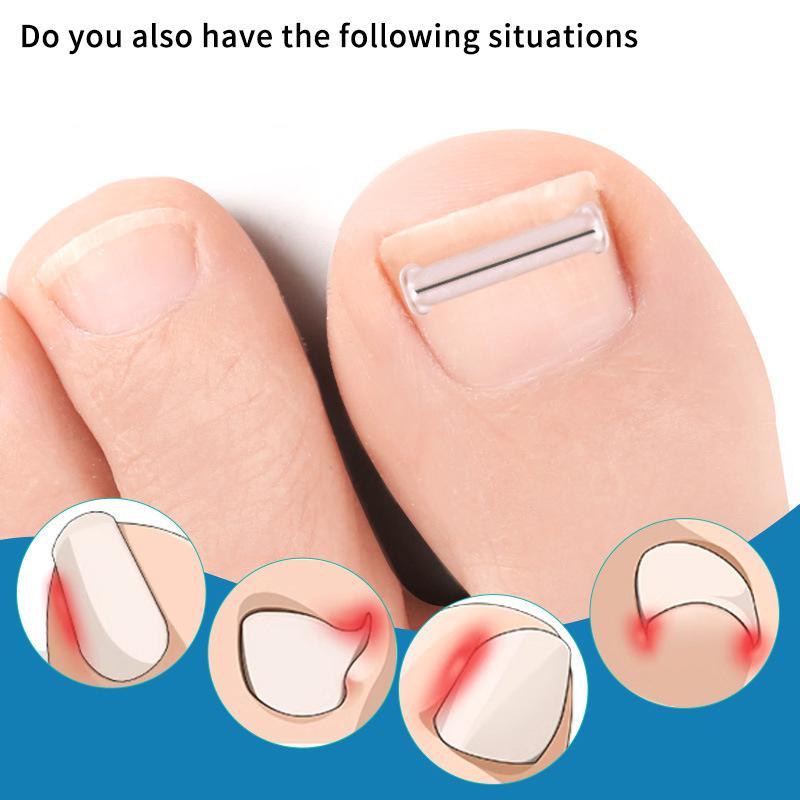 2Pcs Nail Correction Stickers Ingrown Toenail Corrector Patches Paronychia Treatment Recover Corrector Pedicure Tools Foot Care