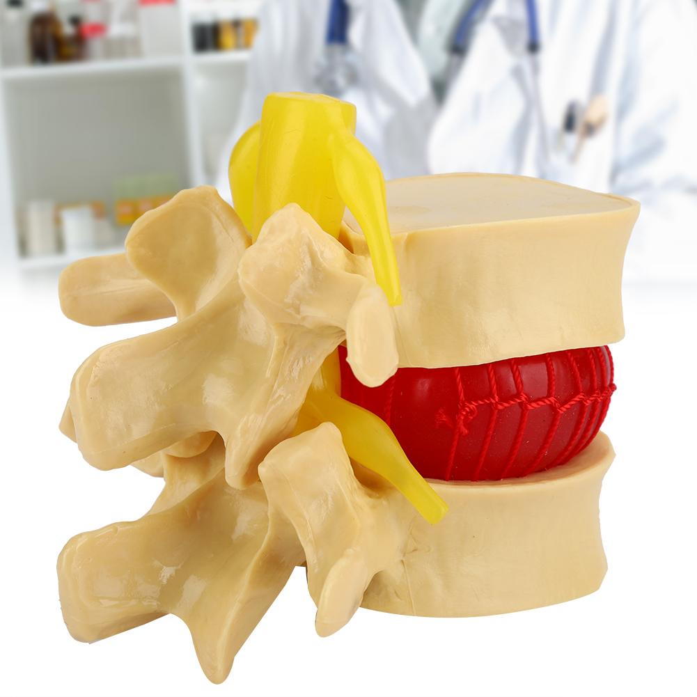1:1.5 Lumbar Disc Herniation Demonstration Model Study Learn Human Spine
