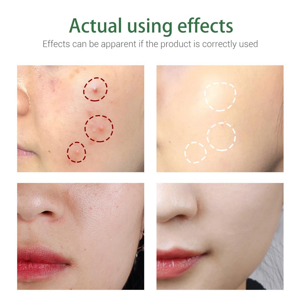 Natural Facial Cleansing Foam Oil Control Acne Cleanser