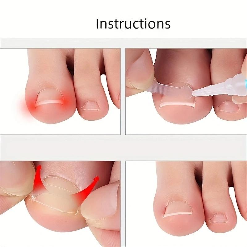 1box Nail Patch Nail Groove Inlay Corrector for Toenail Repair Quick Adhesive Strip