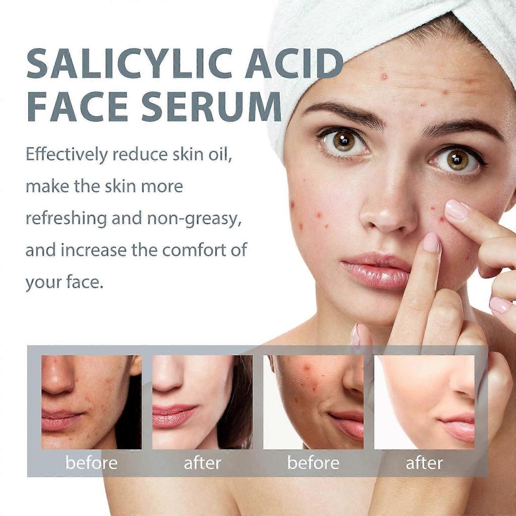 Salicylic Face Serum, Face Serum with Salicylic Acid, Anti-imperfection Serum Contrasts Black Spots and Bruises, Face Serum Reduces Thin Lines