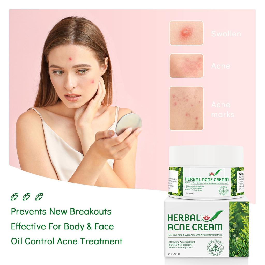 Herbal Acne Creams Anti-Pimple Creams Anti-Acne Creams Acne Balance Water And Oil Skin Blemishes Effective For Body And Face 50g