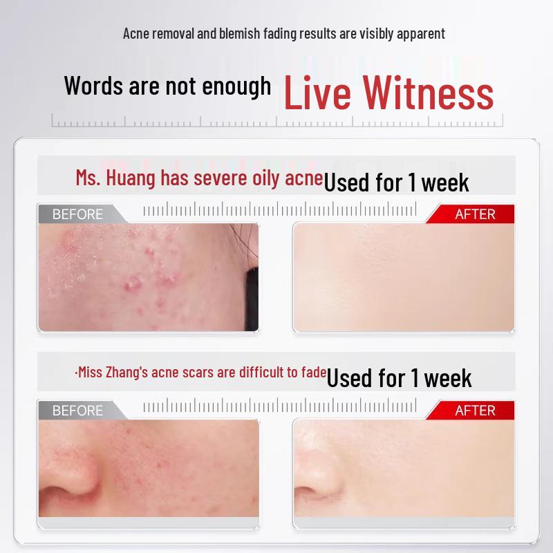 Bailingniao Salicylic Acid Acne Treatment Mask