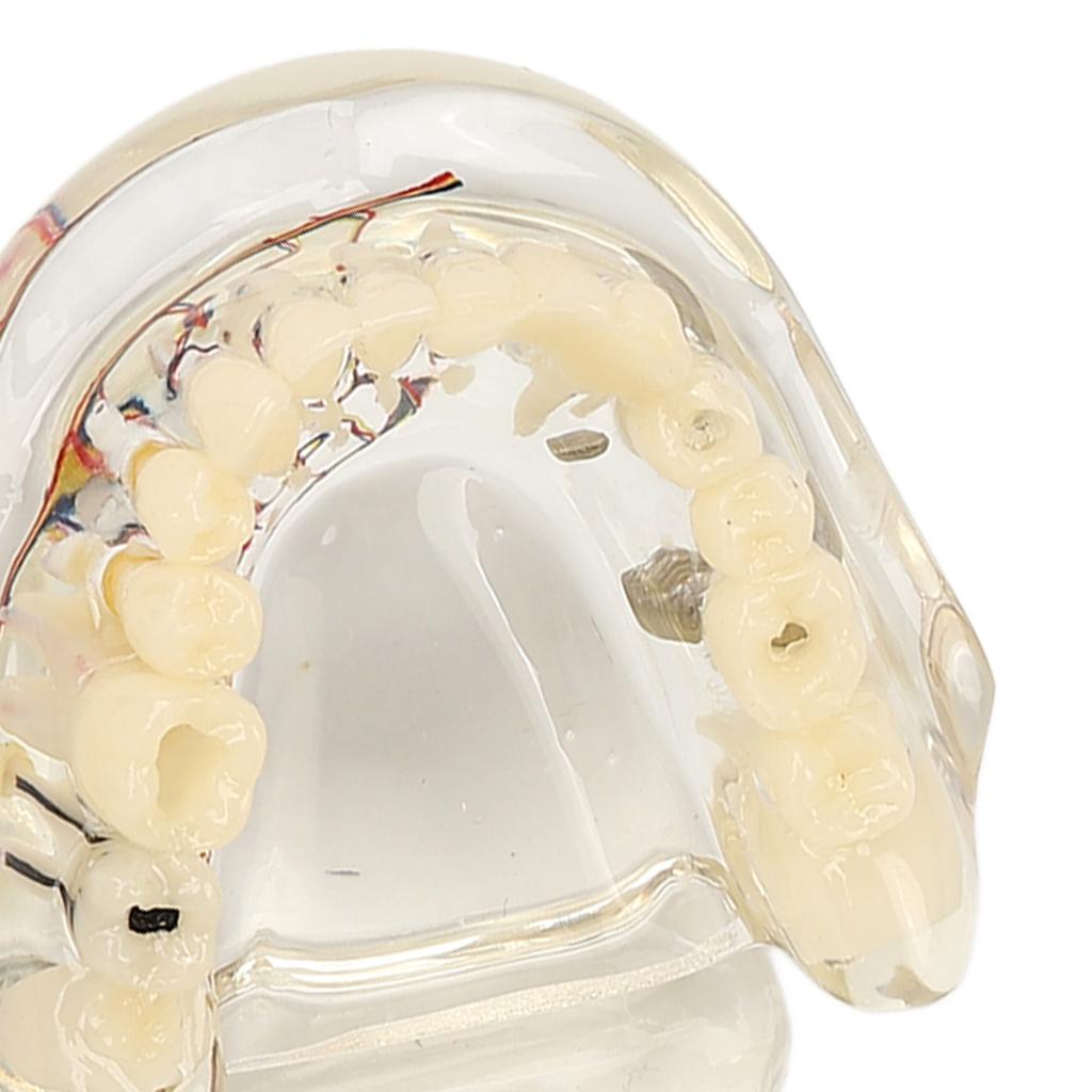 Transparent Dental Implant Pathological Model Implant Disease Teeth Model for Teaching Demonstration