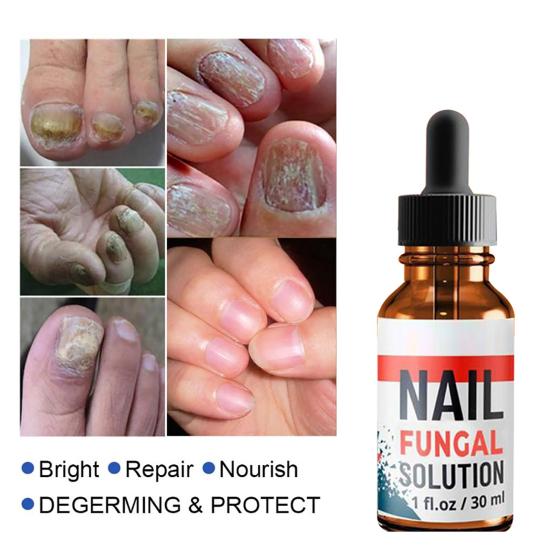 10ml/20ml/30ml Anti Fungus Liquid Toe Finger Nail Infection Repair Treatment