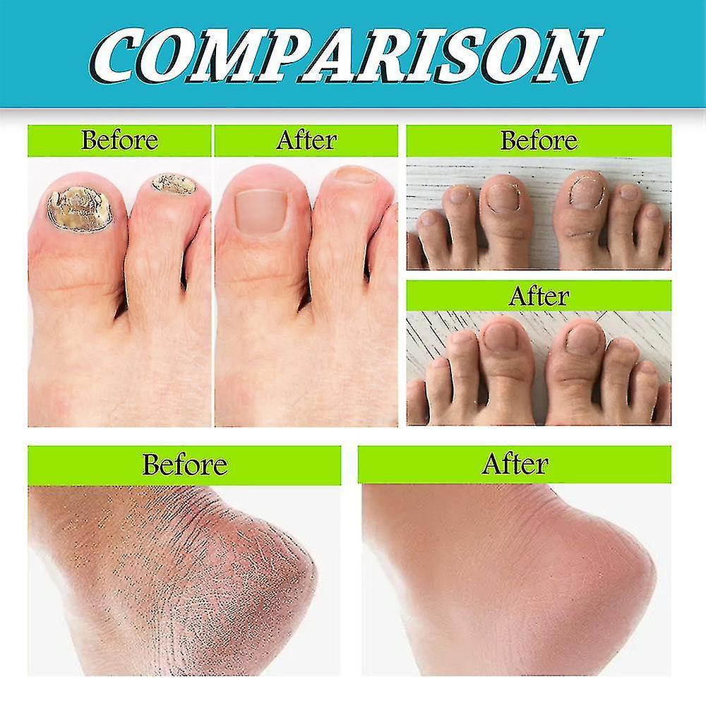 3 pz Spray per Piedi e Unghie, Cura Naturale e Potente per i Piedi