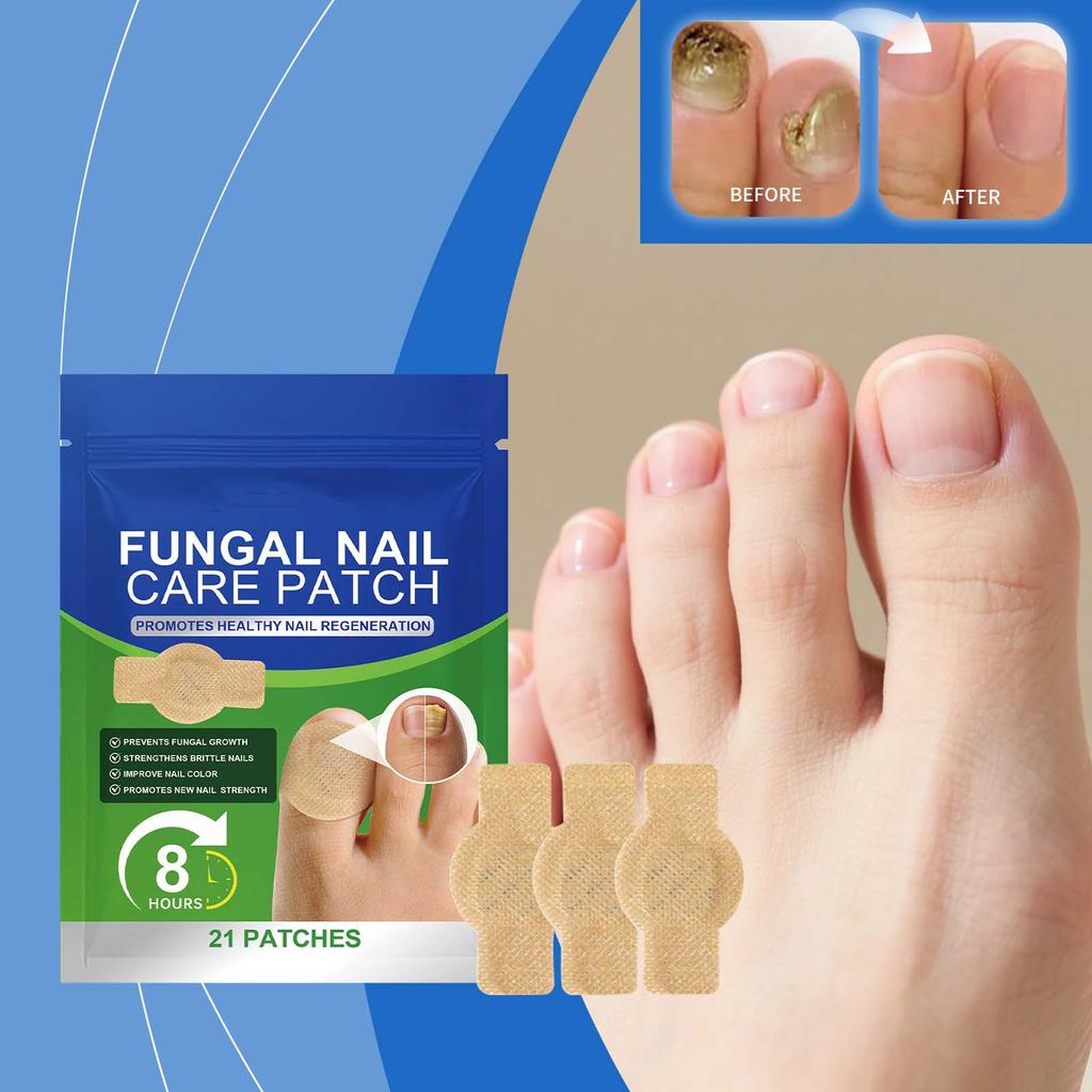 Nail Care Patches, Nail Care Correction Patches, Home Foot Patches, Comfortable And Suitable Nail Correction.