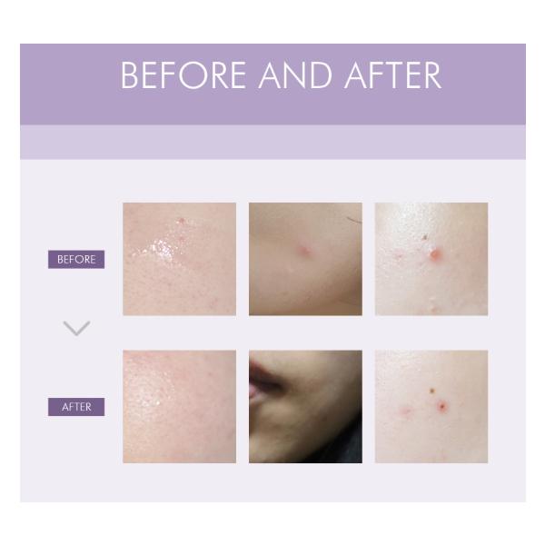 ANACIS Acleon Advanced Blemish Spot Concentrate 30ml