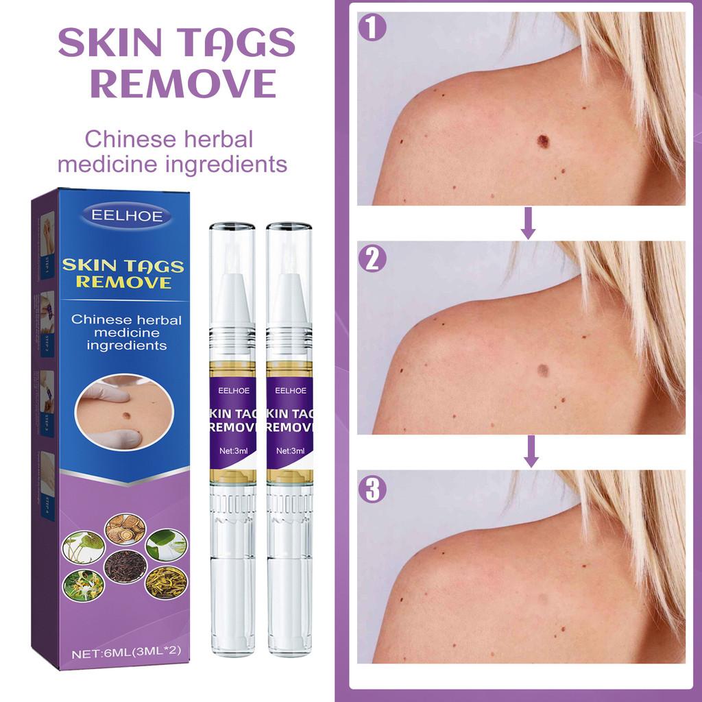 Eelhoe Body Mole Removal Pen Effective Skin Tag Remover For Face Hands And Neck