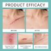 Silicone Scar Patches Moisturize The Skin, Care For Scar, Promote Smooth Skin And Reduce Discomfort.