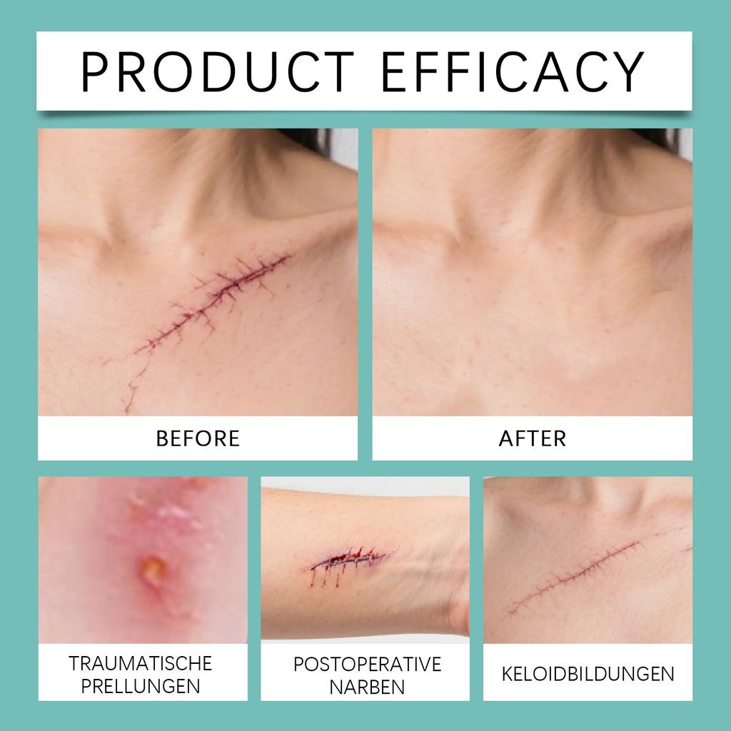 Silicone Scar Patches Moisturize The Skin, Care For Scar, Promote Smooth Skin And Reduce Discomfort.