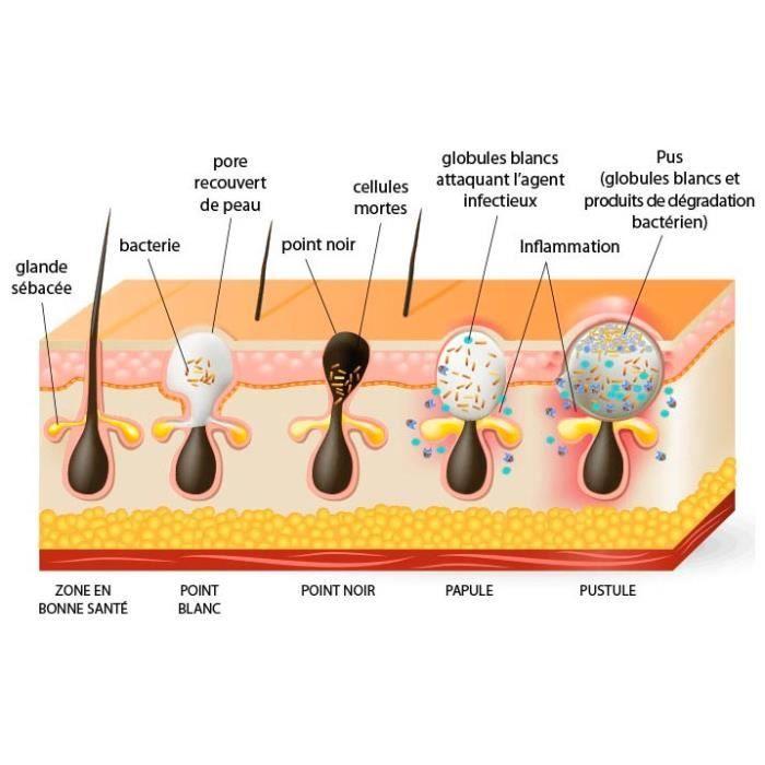 Gezielter Behandlungsstift - SHOP-STORY - Anti-Akne - Lichttherapie - Hypoallergen - LED