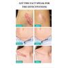 1PC After Burn Fading Skin Ointment