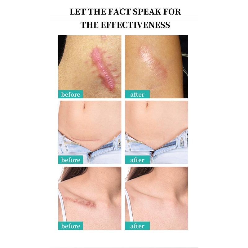 1PC After Burn Fading Skin Ointment